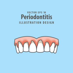 蓝牙周炎人牙龈炎症图示向量图片