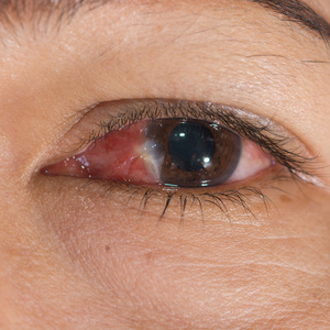 哪一个生命采用灰尘和家具有领圈的阿拉卡列-翼状胬肉扭矩和扭矩一次