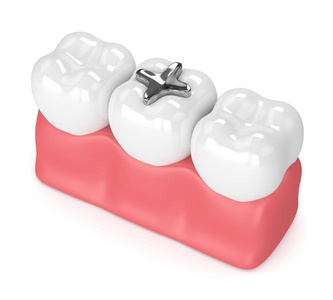 3d. 牙科汞合金填充牙的呈现