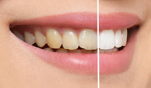 牙齿使用前和一周后对比微笑的妇女前和后牙齿美白程序, 特写照片