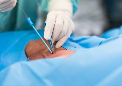 穿刺颈内静脉中心静脉压的照片