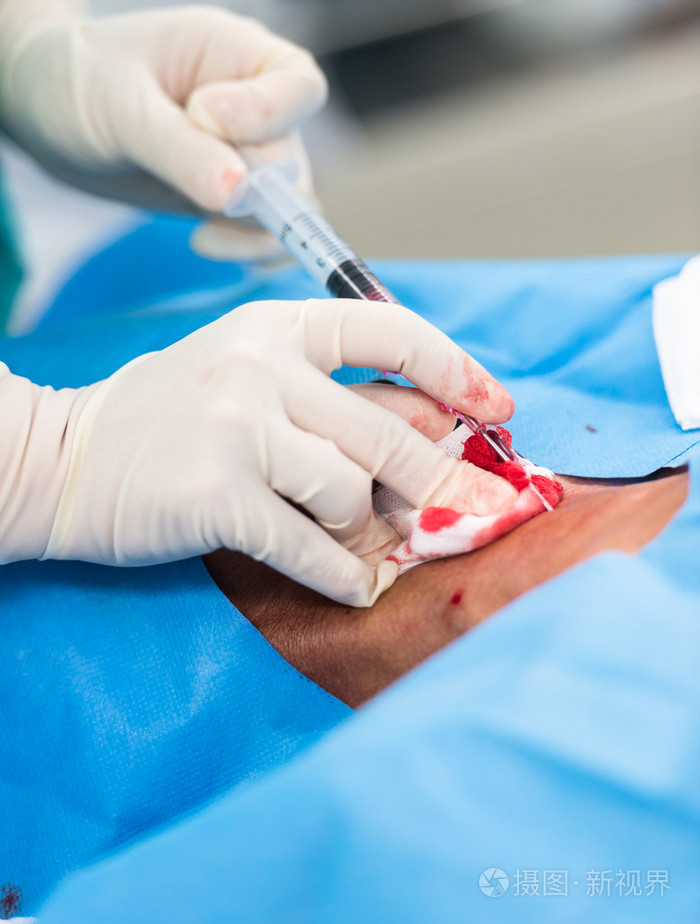 穿刺颈内静脉中心静脉压的