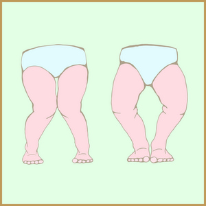 踝内翻膝内翻, 膝外翻-物理双腿畸形照片