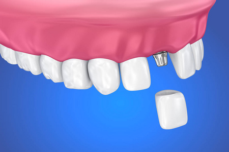 牙种植和冠安装过程。医学上精确的3d 例证
