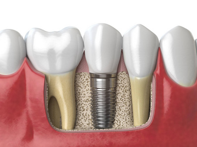 人 dentu 牙牙种植体的解剖学研究