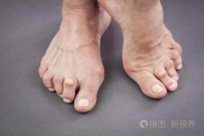 变形从类风湿关节炎的女人的脚
