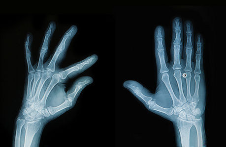 x 射线的手和手指