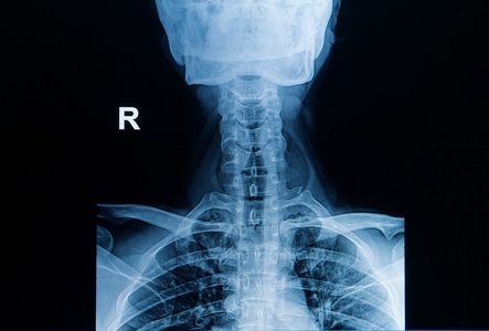 颈椎x光片正面图片