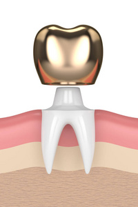 3d. 牙科金冠充填牙