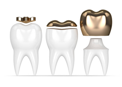 3d 不同类型牙齿金填充牙的呈现