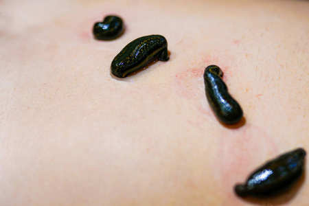 水蛭女人的身体护理与肚脐周围的笑脸在理疗中心接受腹部按摩的妇女