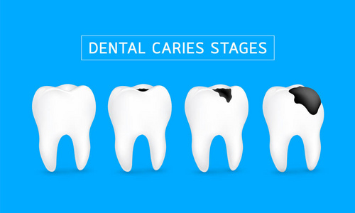龋病发展阶段。牙科关心概念, 例证在蓝色背景被隔绝了
