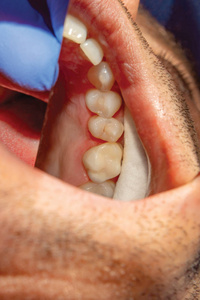 人牙龋病的治疗。用复合材料修复牙齿牙齿的概念