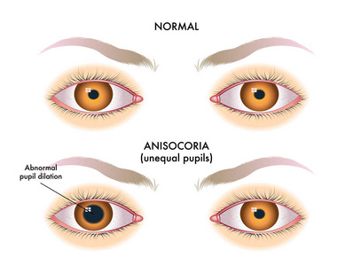 anisocoria 的矢量插图。不同大小的学生