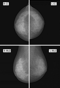 左乳腺上部外象限 calcinates 小点照片