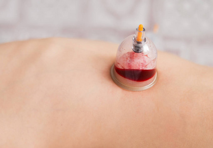 Hijama 流血。另类医学