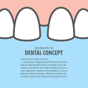 布局特写空隙上齿图示矢量蓝色