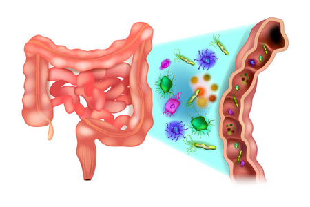Dysbiosis 也称为菌群失调。肠道结肠菌的菌群失调