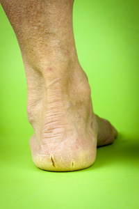 裂纹的脚跟图片