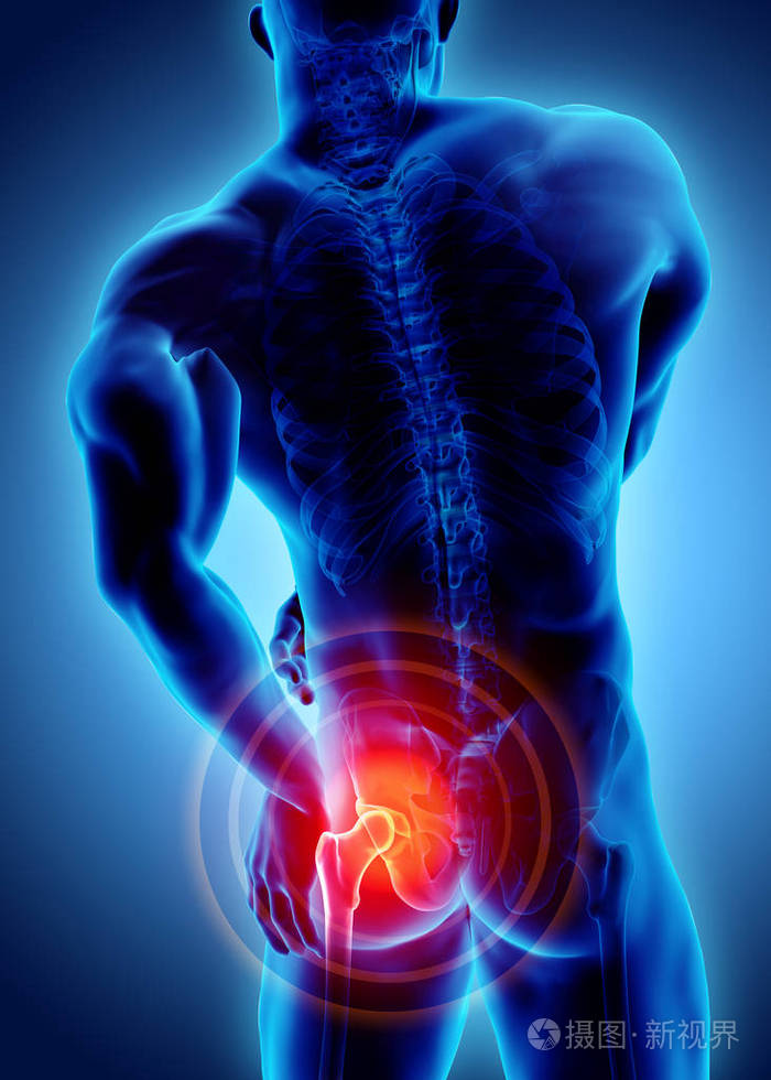 髋关节痛骨骼 x 射线,3d 图