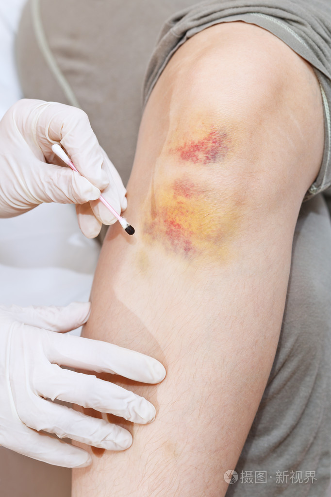 碘网格画的膝盖瘀青