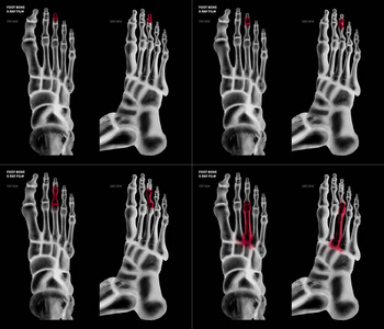 不同疼痛和关节部位的中趾足骨 X 线片收集顶部和侧面保健人体解剖和医学概念在黑色背景下隔离