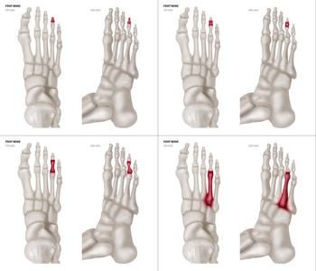 不同疼痛和关节部位的红胸环趾足骨 X 线收集顶部和侧面保健人体解剖和医学概念在白色背景下隔离