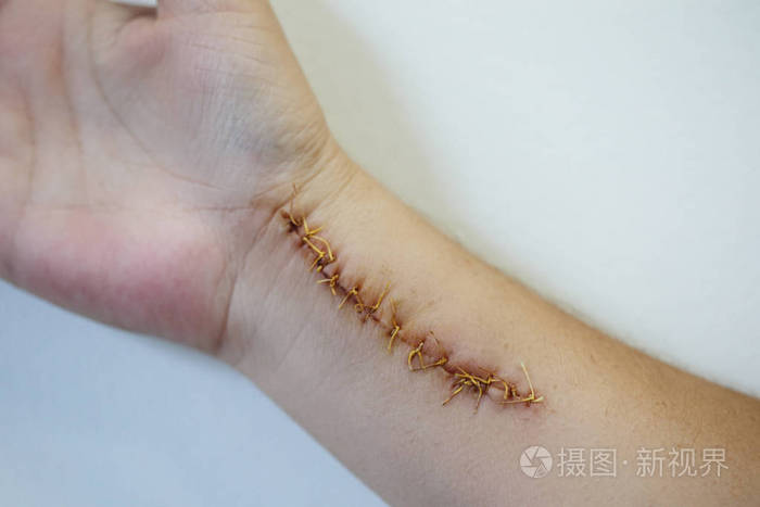 末叶手伤了一个大伤疤, 缝了很多针.水平射击照片-正版商用图片085g6j