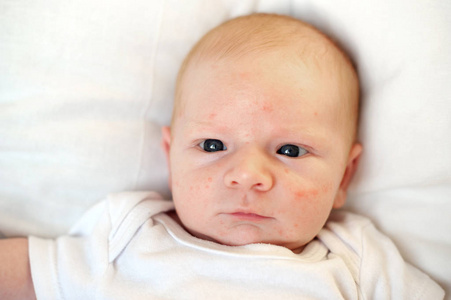 婴儿面部过敏性皮炎