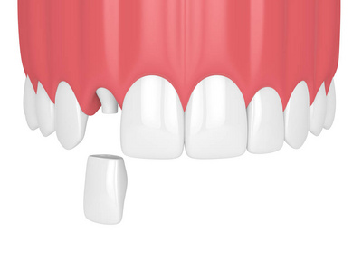 3d. 在白色背景下, 用牙齿和牙齿侧切牙冠上颌骨渲染