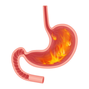 pyrosis 胃隔离的现实医学例证。胃内的火紊乱
