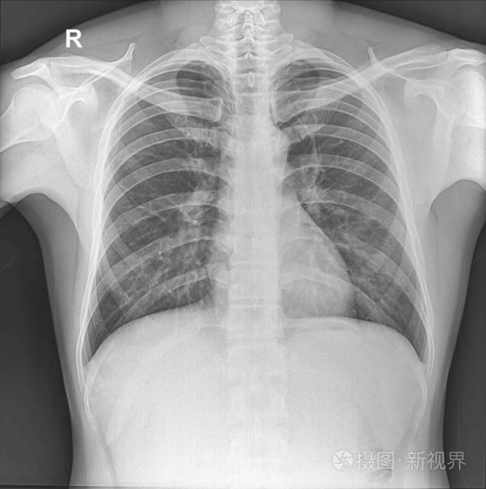 胸部x光机直立显示正常人的胸部