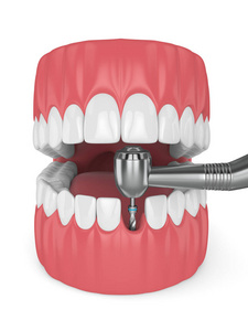 3d. 用牙种植机进行下巴的渲染。植入过程概念