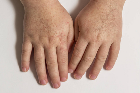 猩红热.两个孩子手里有传染性的红色小皮疹.白色背景照片