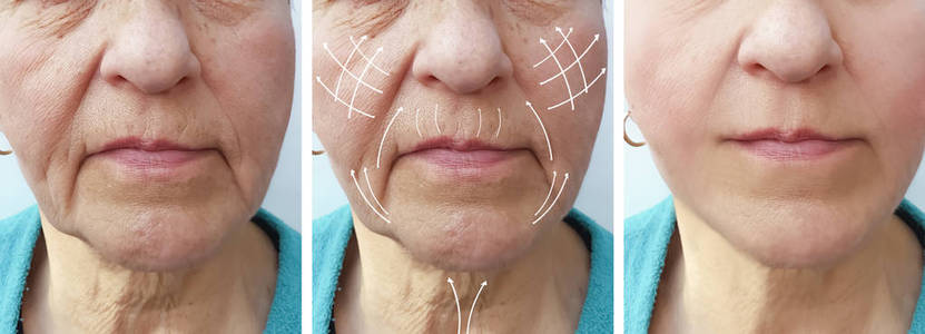 老年妇女面部皱纹矫正前后程序箭头