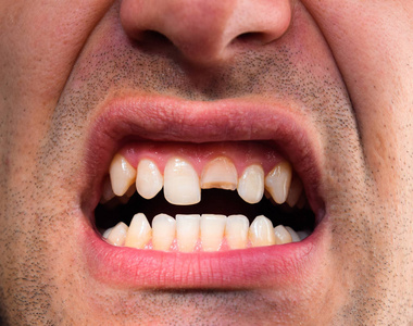 牙齿断了在一个男人嘴里断了上切牙。男子向牙医展示口腔。断牙的治疗