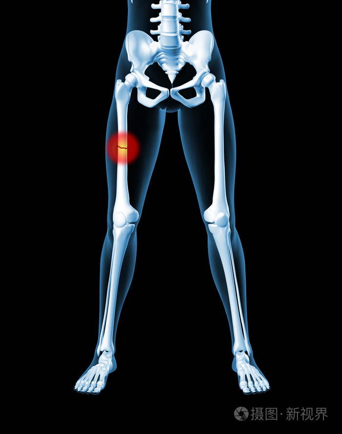 腿断的骨的女性骨骼