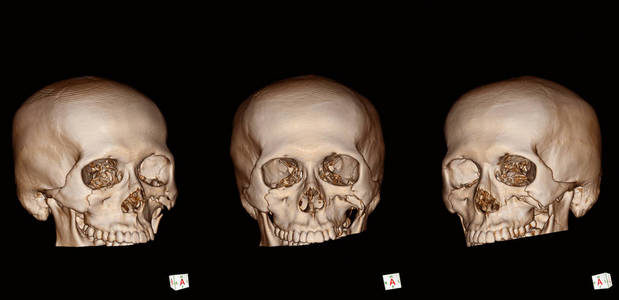 颅内骨3d 的 ct 扫描全分辨率下的人颅骨骨折过于模糊和柔软照片