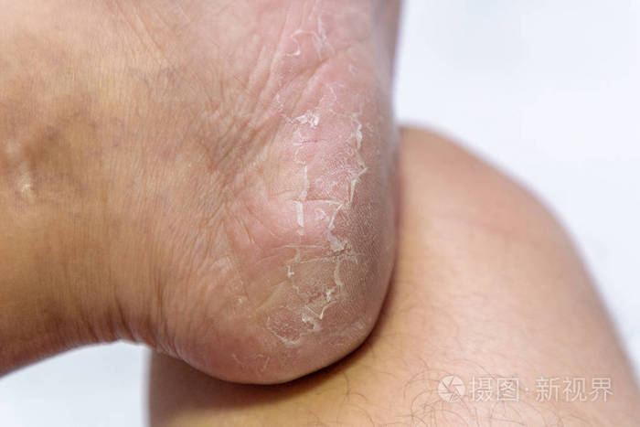 闭合性脚跟断裂皮炎 足部男性皮肤脱皮照片 正版商用图片08n1rt 摄图新视界 闭合性脚跟断裂皮炎 足部男性皮肤脱皮照片 正版商用图片08n1rt 摄图新视界