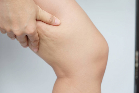 女性腿大腿与脂肪团.