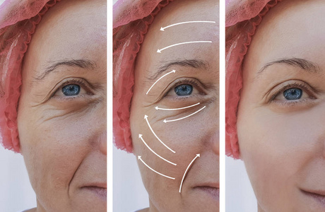 妇女脸皱纹矫正前后的程序, 箭头