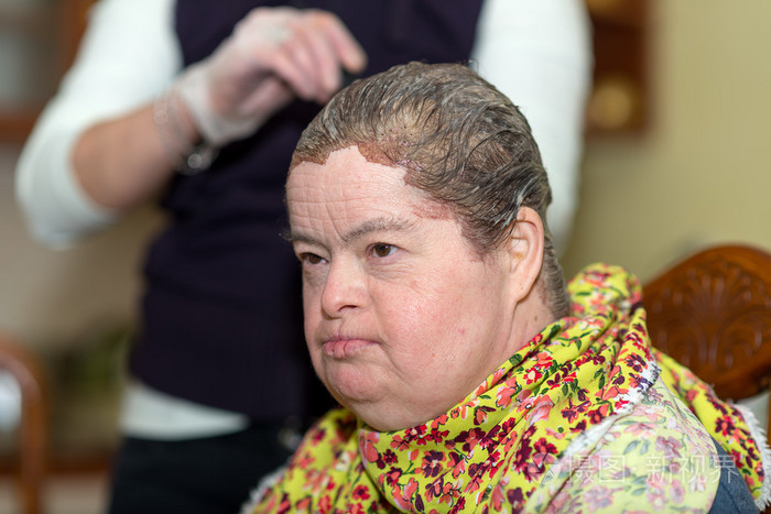 唐氏综合征的女人