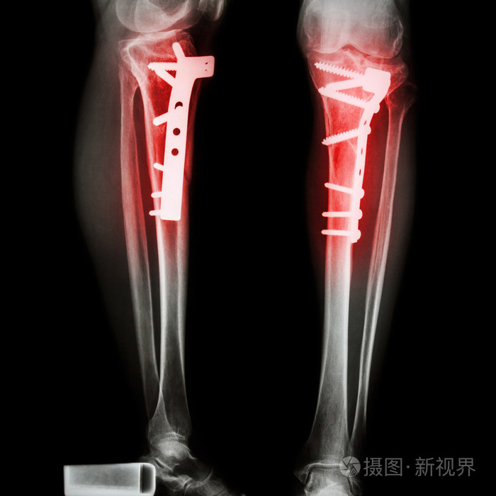 胫骨骨折 腿骨 照片 正版商用图片08uqbz 摄图新视界