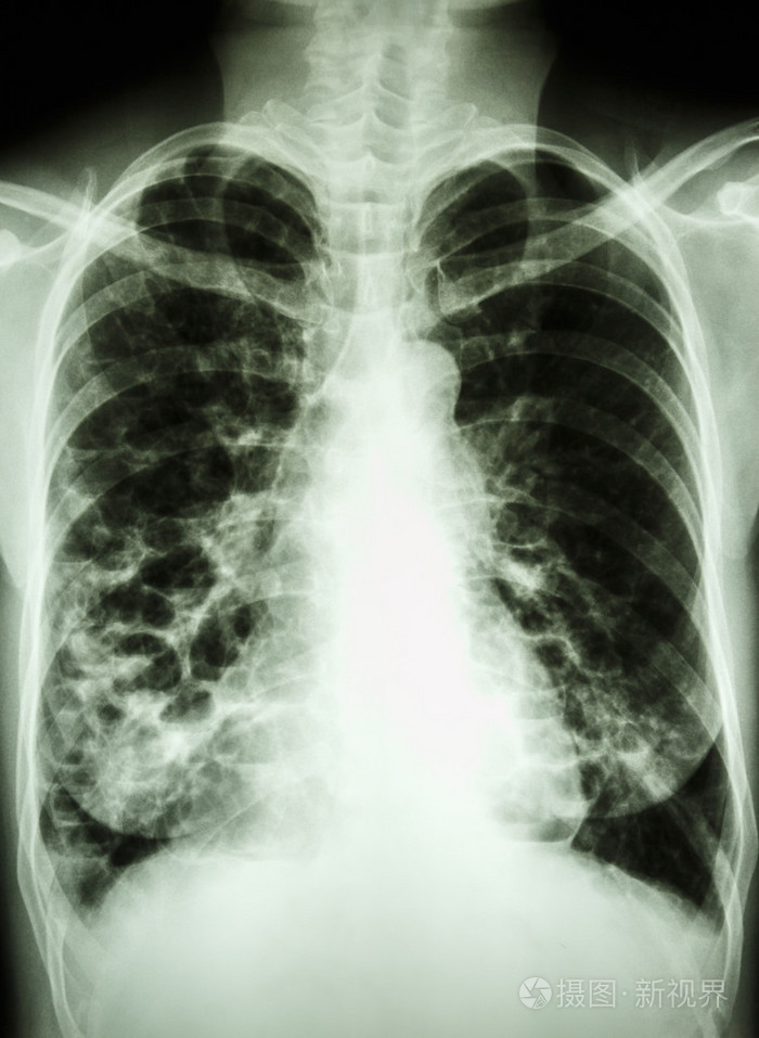 慢性支气管炎 胸片图片