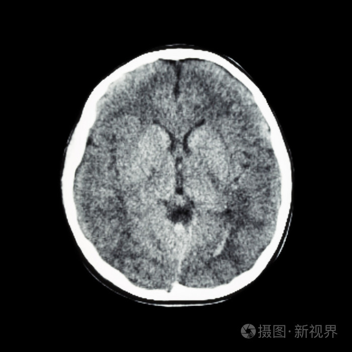 大脑正常ct扫描计算机断层扫描