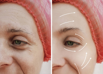 女性面部皱纹之前和之后整容手术, 箭