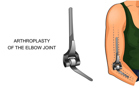 肘关节 endoprosthesis 的矢量图解