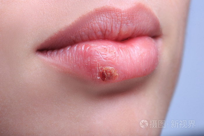 美丽的双唇疱疹病毒感染照片 正版商用图片0919nb 摄图新视界 美丽的双唇疱疹病毒感染照片 正版商用图片0919nb 摄图新视界