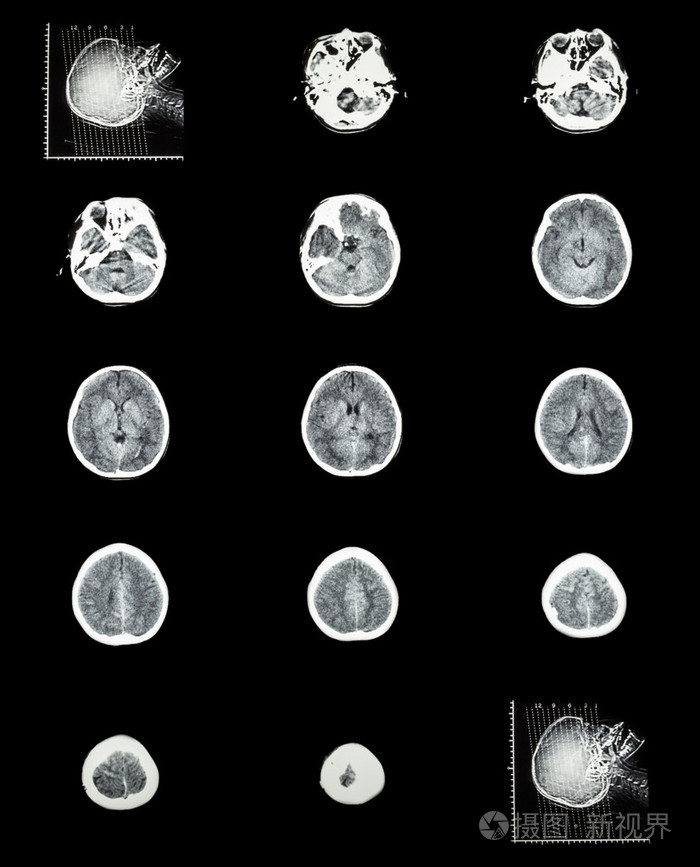 正常的大脑 (脑血管 ct 扫描 (计算机断层扫描)