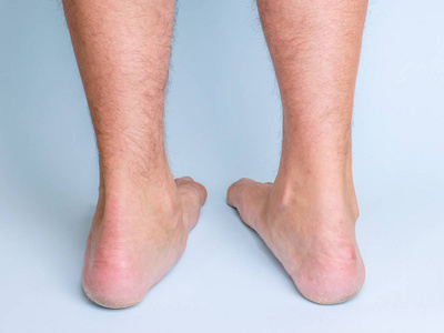 一个人的腿有明显的扁平脚。后视图。腿部和关节疾病